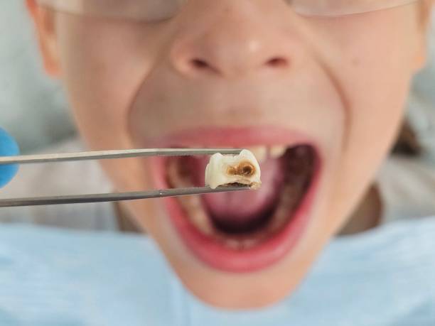 Best Broken or Cracked Tooth Emergency Dentist in Gilmer, TX
